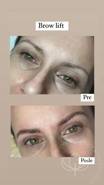 brow lift pre i posle 1200