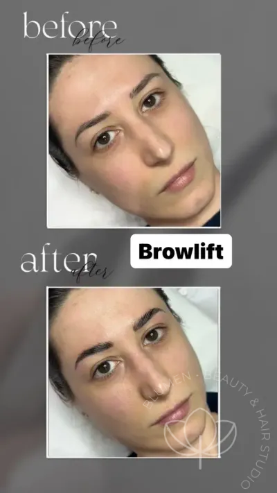 browlift pre posle 1200