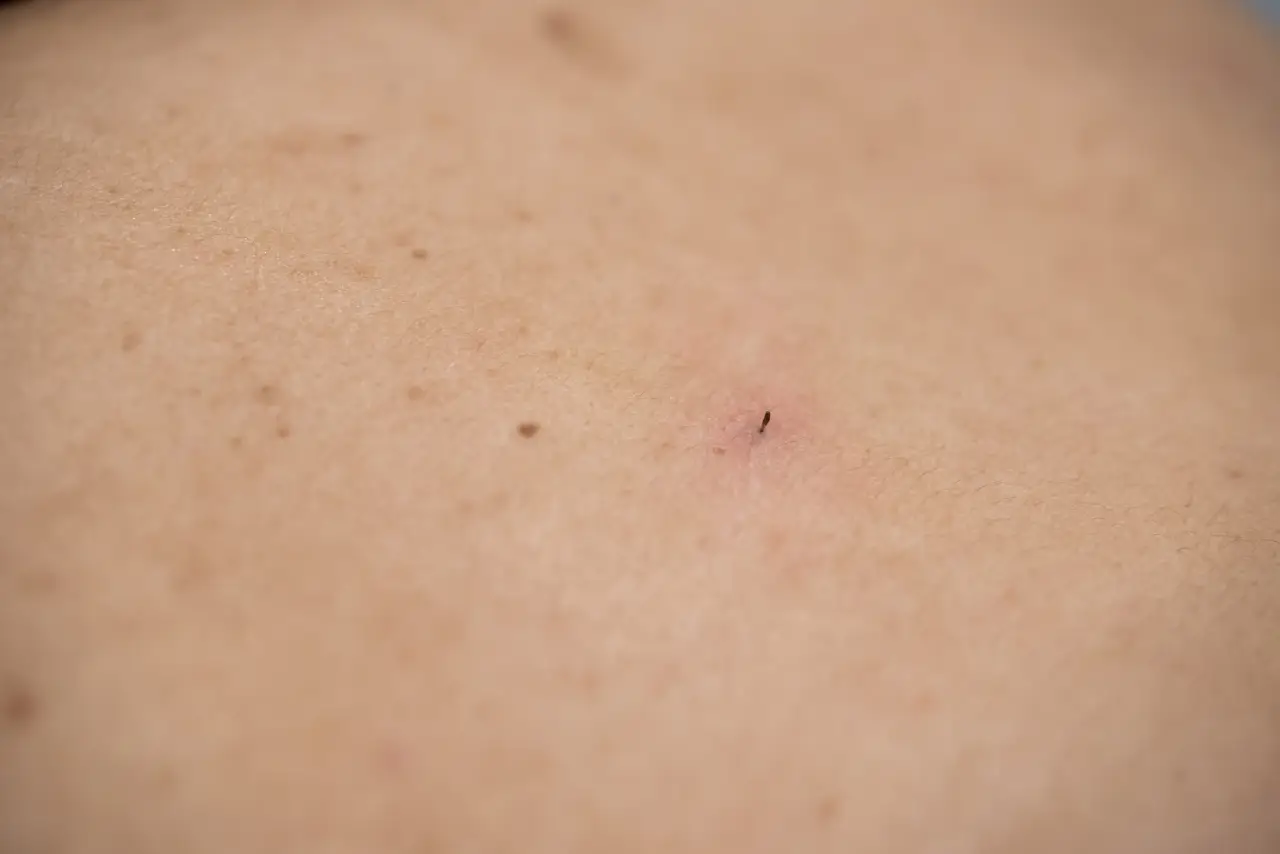 Urasle dlake na koži - problem koji rešava laserska epilacija u Blumen Beauty Studio