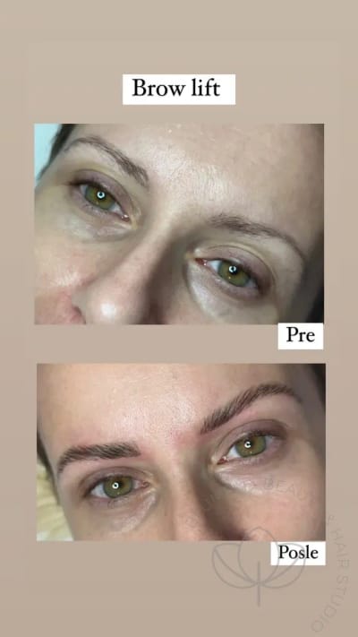 brow lift pre i posle 1200