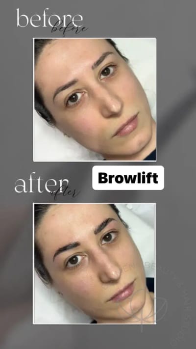 browlift pre posle 1200